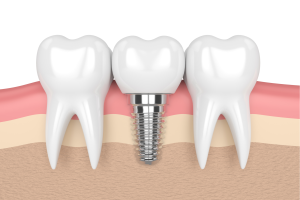 dental implants, dental implants in concord, dental implants in lexington